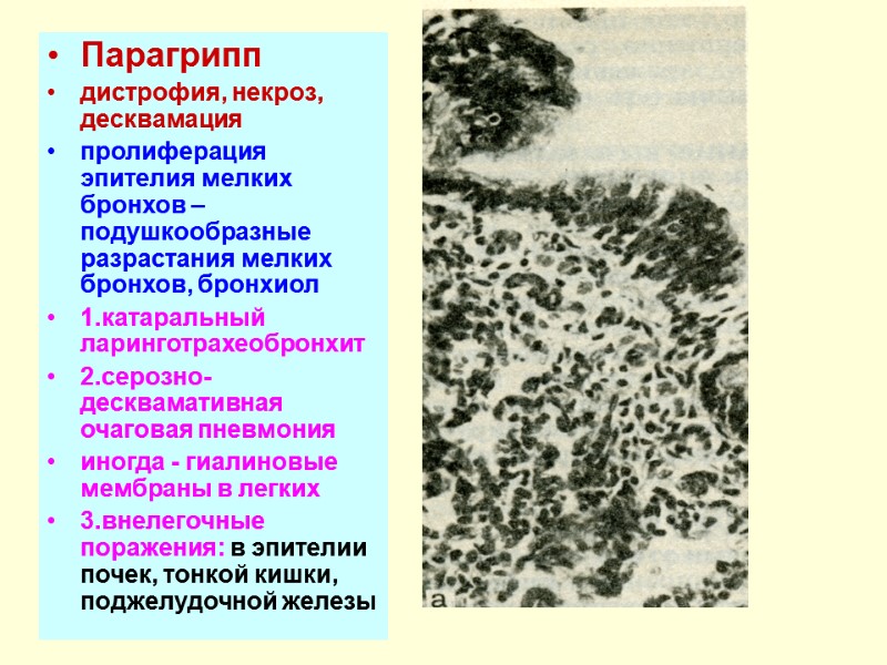 Парагрипп  дистрофия, некроз, десквамация пролиферация эпителия мелких бронхов – подушкообразные разрастания мелких бронхов,